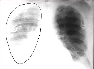 Ruptura aórtica, radiografía de tórax