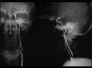 Estenosis carotídea; radiografía de la arteria izquierda