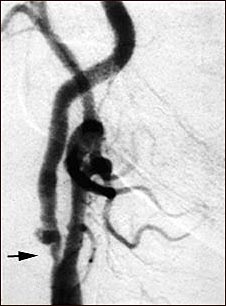 Estenosis carotídea; radiografía de la arteria derecha