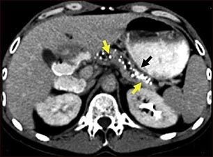 Tomografía computarizada de una pancreatitis crónica