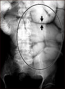 Ileo: Radiografía de la distensión intestinal
