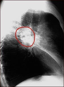 Cáncer de pulmón- Radiografía lateral del tórax