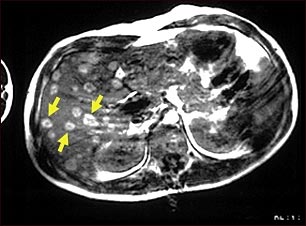 IRM del melanoma del hígado