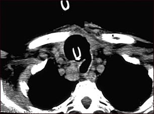 Tomografía computarizada de cáncer de tiroides