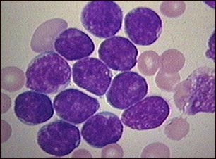 Microfotografía de leucemia linfocítica aguda