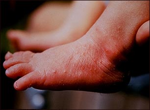 Eritema tóxico en el pie