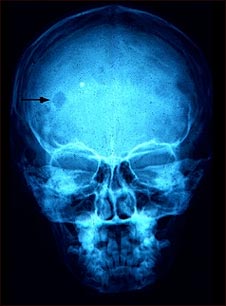 Granuloma eosinofílico- Radiografía del cráneo