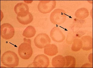 Malaria, fotomicrografía de parásitos celulares