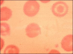 Glóbulos rojos de la sangre, células en diana