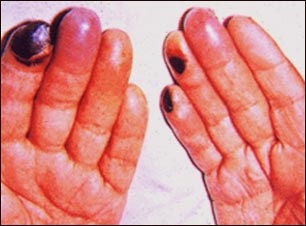 Crioglobulinemia de los dedos