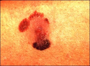 Cáncer de piel, melanoma maligno