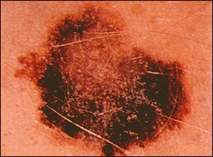 Cáncer de piel o melanoma: lesión superficial parda