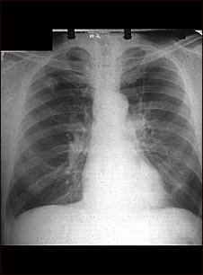 Adenocarcinoma; placa de rayos X de tórax