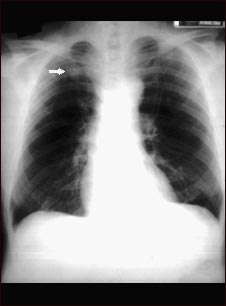 Nódulo pulmonar; vista frontal en placa de rayos X de tórax