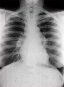 Sarcoidosis, estado I - radiografía de tórax