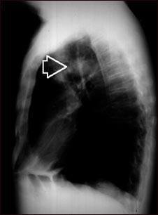 Masa pulmonar - Vista lateral de la radiografía de tórax