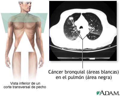TC de cáncer bronquial