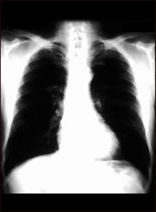 Cáncer bronquial - radiografía de tórax
