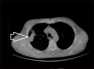 Masa pulmonar, pulmón derecho - Tomografía.