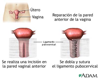 Reparación de la pared vaginal anterior