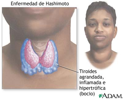 Enfermedad de Hashimoto (tiroiditis crónica)