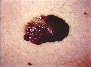 Cáncer de piel o melanoma: lesión oscura saliente