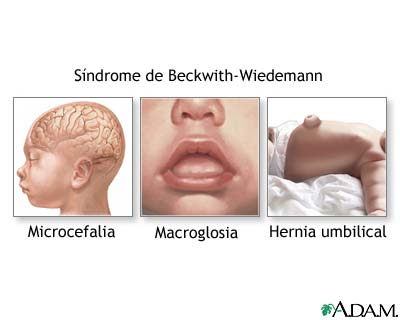 Síndrome de Beckwith-Wiedemann