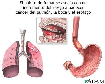 Tabaco y cáncer