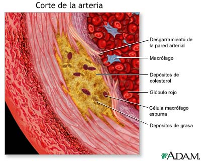 Vista agrandada de la aterosclerosis