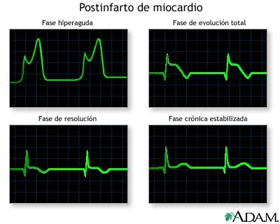 Gráficos de las ondas del ECG después del infarto al miocardio