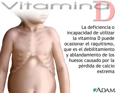 Déficit de vitamina D