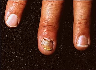 Infección candidiásica de la uña