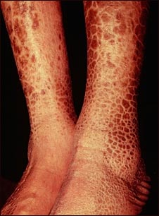 Ictiosis adquirida en las piernas
