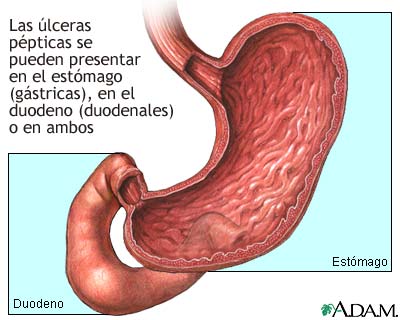 Ubicación de las úlceras pépticas