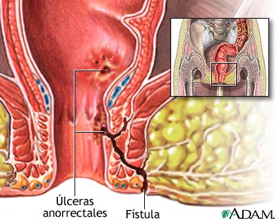 Fístulas anorrectales