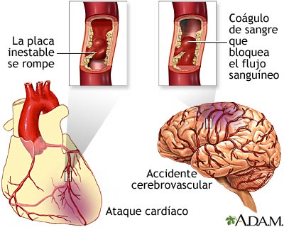 Acumulación de placa en las arterias