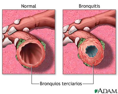 Bronquitis y condición normal de los bronquios terciarios
