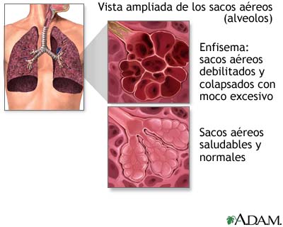 Enfermedad pulmonar obstructiva crónica (EPOC)