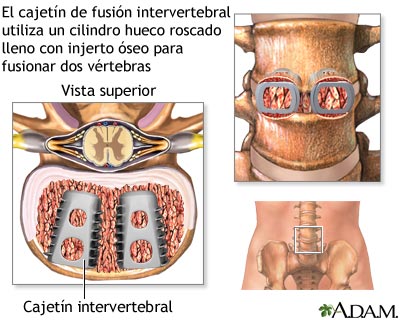 Cajetín de fusión intervertebral