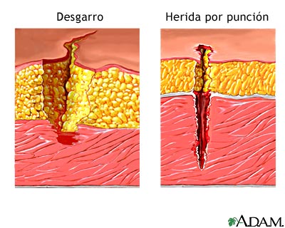 Desgarro versus herida penetrante
