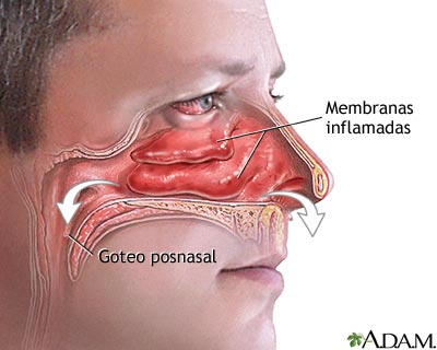 Goteo y congestión nasal