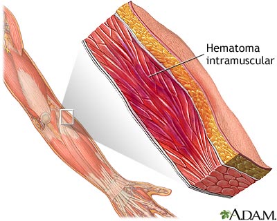 Hematoma muscular