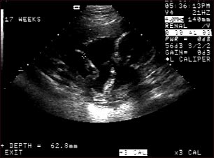Ultrasonido de un feto normal; brazos y piernas