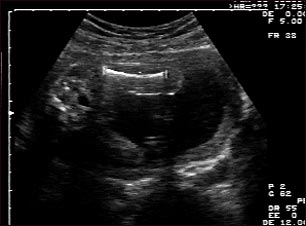 Ultrasonido de un feto normal; medidas del fémur