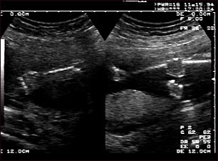Ultrasonido normal - brazos y piernas del feto
