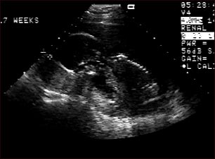Ultrasonido de un feto normal; vista de perfil
