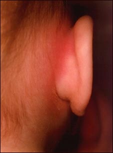 Mastoiditis - enrojecimiento e hinchazón detrás del oído