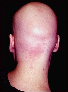 Alopecia total; vista posterior de la cabeza
