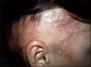 Alopecia bajo tratamiento