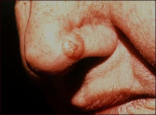 Cáncer de piel o carcinoma de célula basal en la nariz
